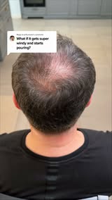 Seeing More Scalp Lately?