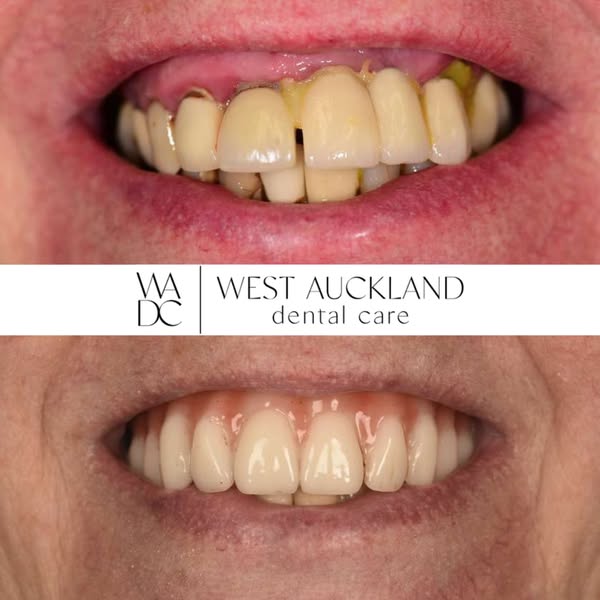 Dental Implant Deal | Restore Your Smile