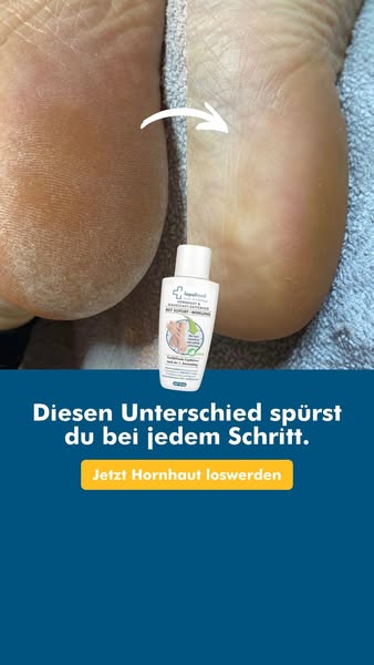 Lopalmed Hornhaut-Entferner ( 4,9/5)