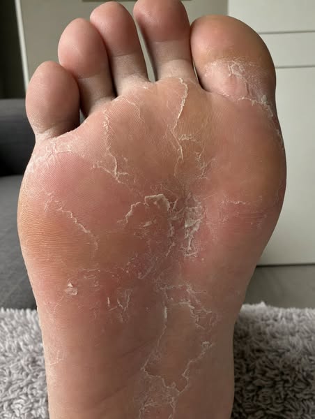 Eliminate Athlete’s Foot Today.