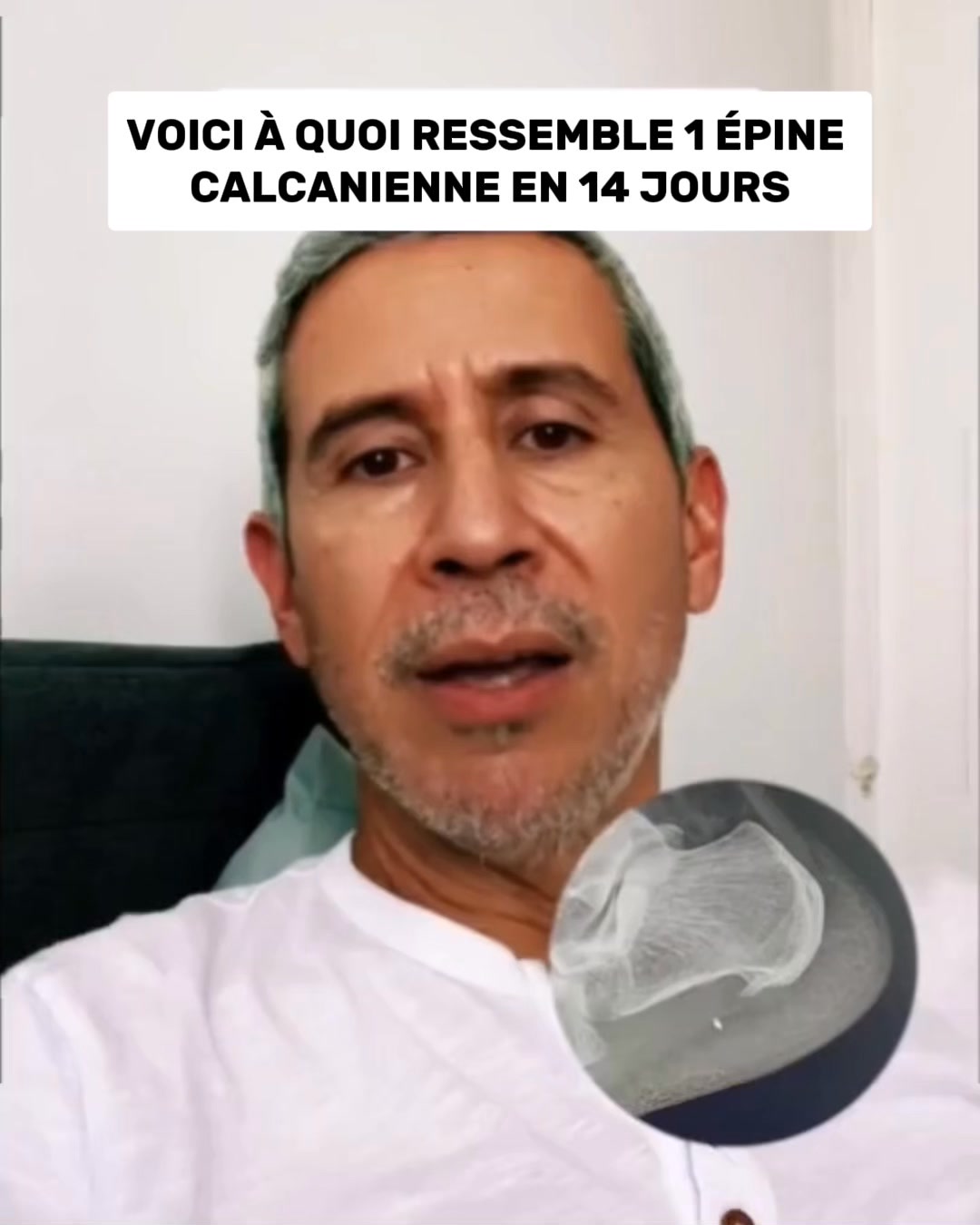 La vraie cause du talon douloureux.