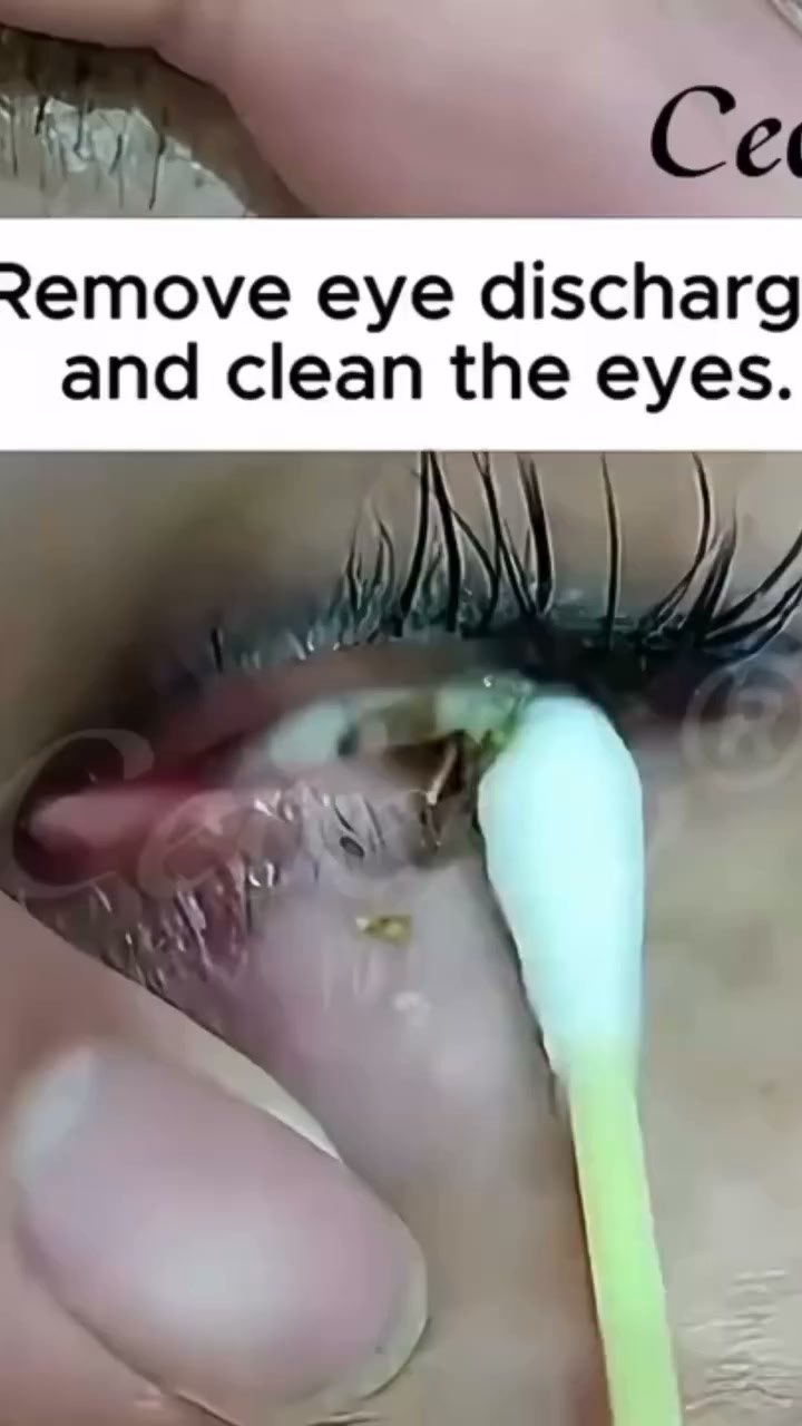Cooling Relief for Your Eyes
