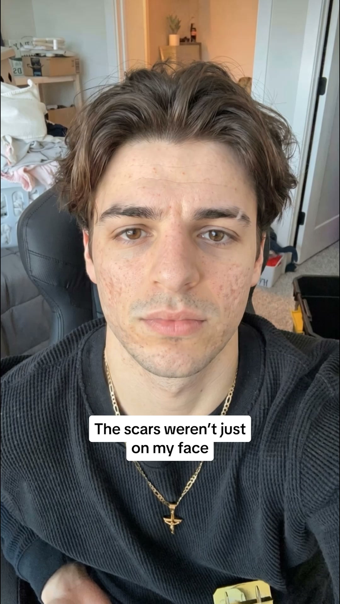 PDRN Heals Acne Scars