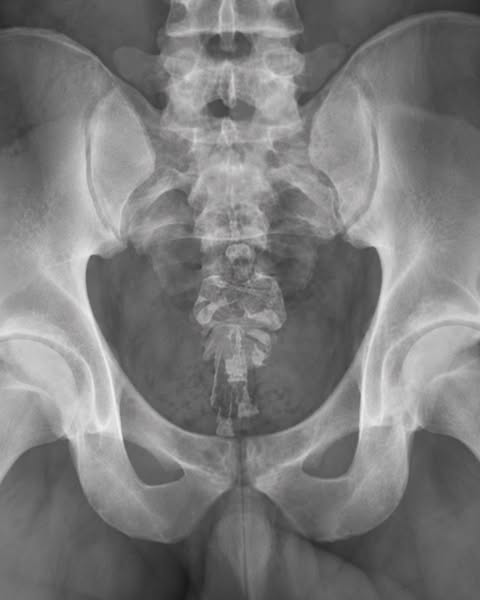 Reduce bladder leaks — naturally