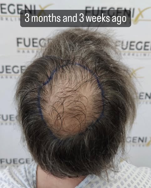 FueGenix | Exclusive Hair Transplant