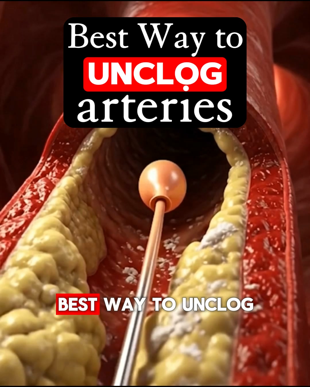 Got Artery Plaque? What Are You Waiting For?