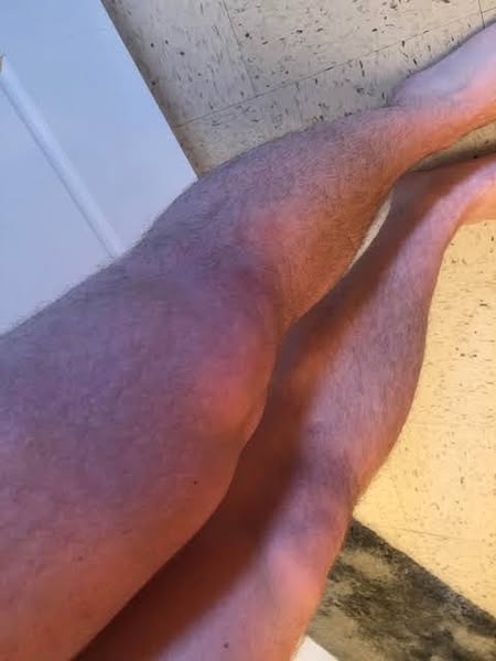 I Refused Anti-Inflammatories for 3 Years. Here's What Happened to My Arthritis.