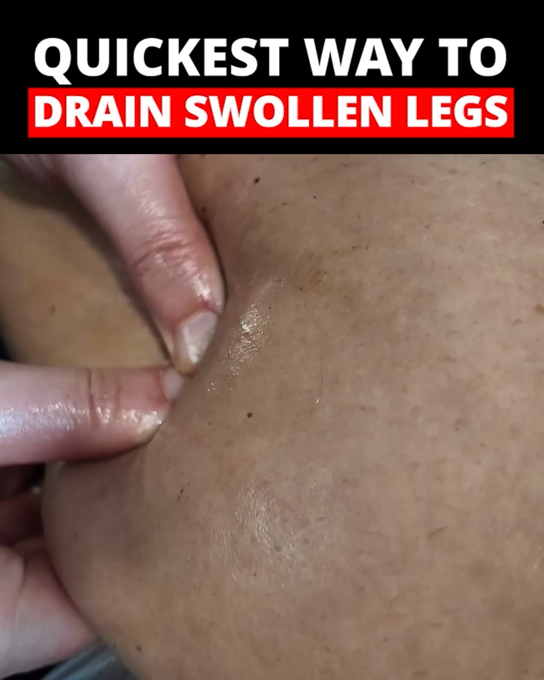 Fastest Way To Drain Swollen Legs