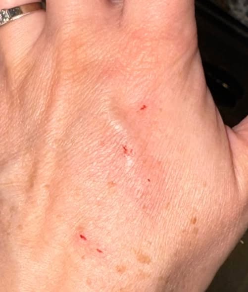 The day my dog bit me