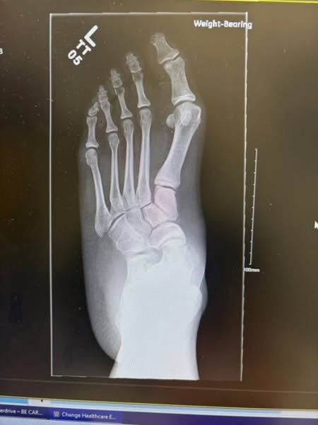 A Physical Therapist's Confession: Why Most Plantar Fasciitis Treatments Make the Problem Worse