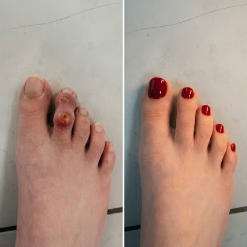 Read this if you suffer from hammertoes