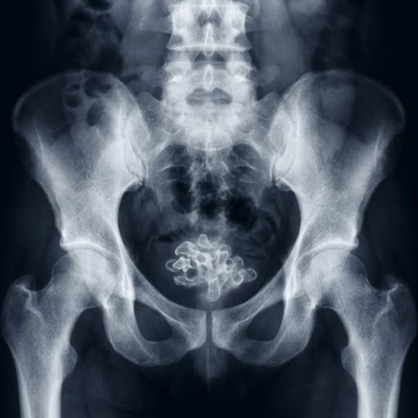 Every woman with recurring UTIs needs to see this