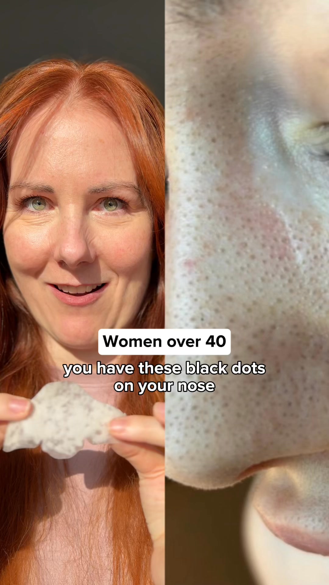 Stop Treating Blackheads Wrong