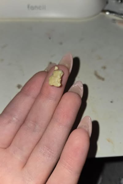 Mis piedras en las amígdalas pasaron por 6 etapas — yo me enteré en la 4 El mal aliento era la etapa 2. Yo lo ignoré por años.