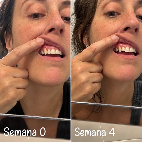 Leia isto se as suas gengivas estão a retrair