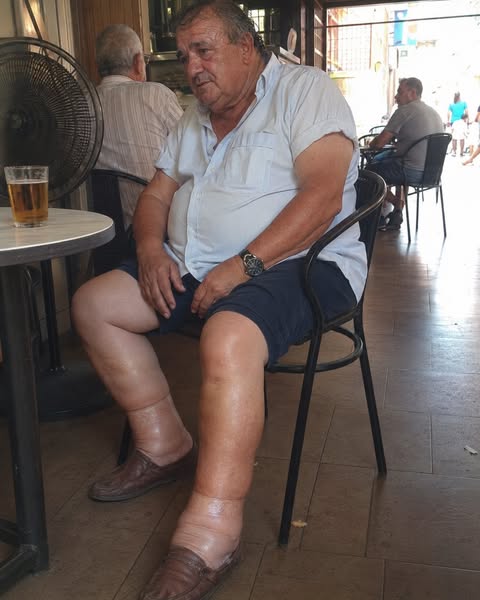 La hinchazón en las piernas...
