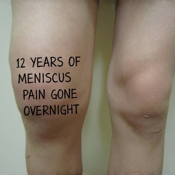 Meniscus recovery taking longer than they promised?