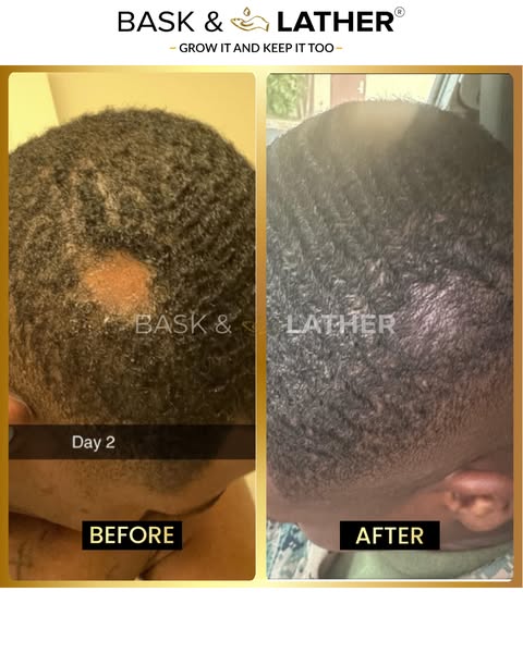 Scalp Stimulator