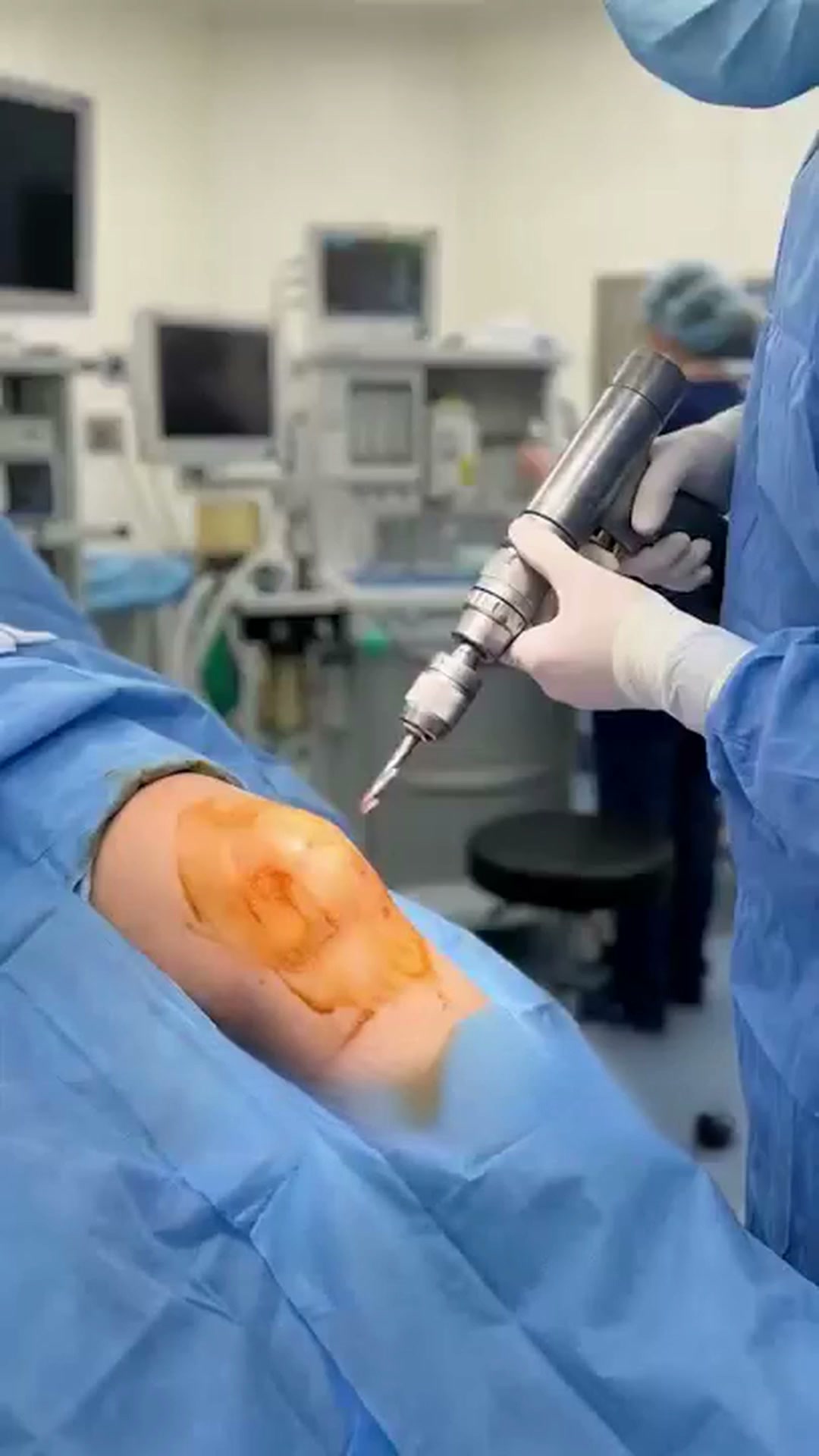 Knieschmerzen oder Arthrose?