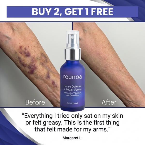 Bruises Gone In Days!