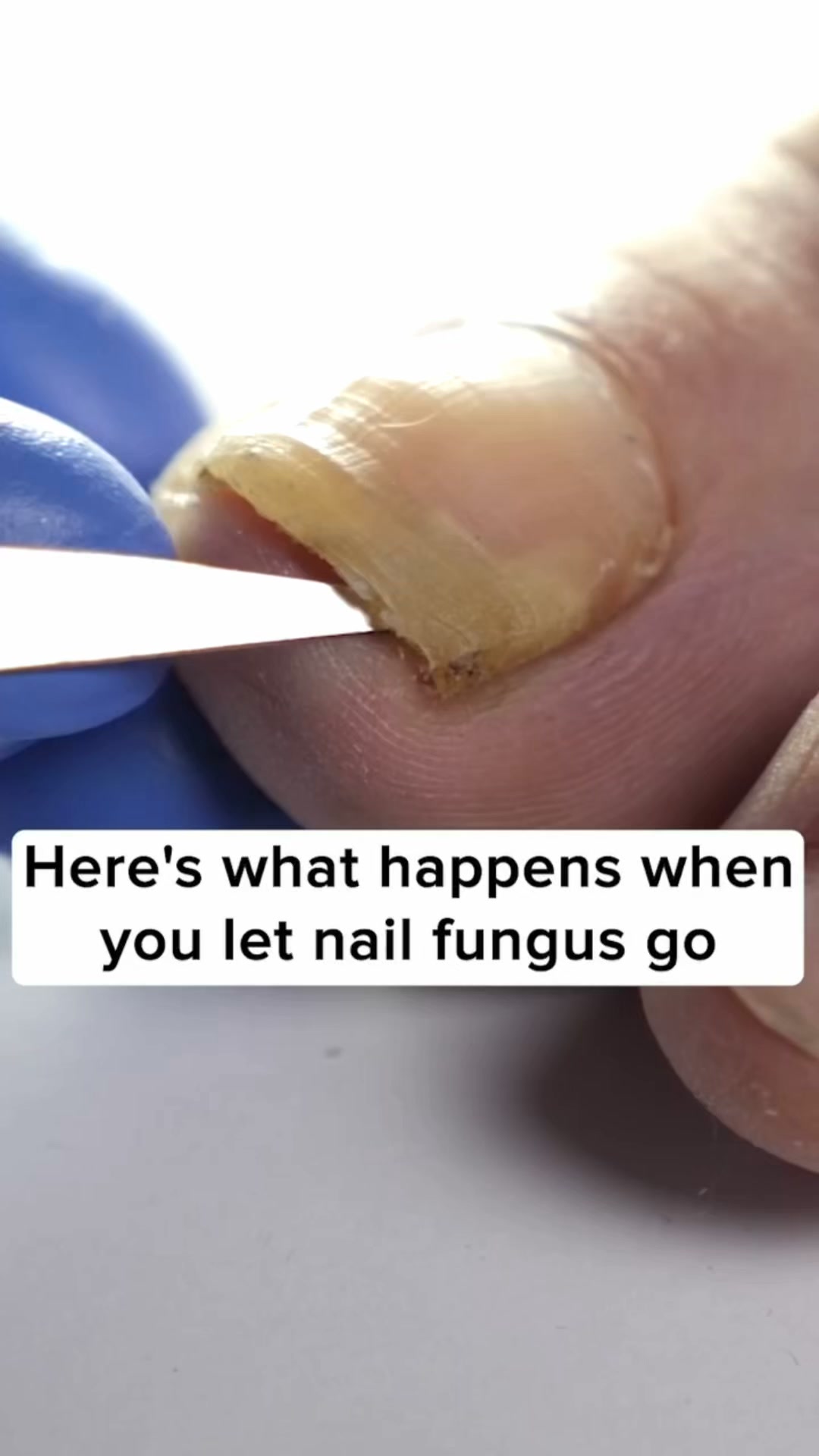 No More Nail Fungus