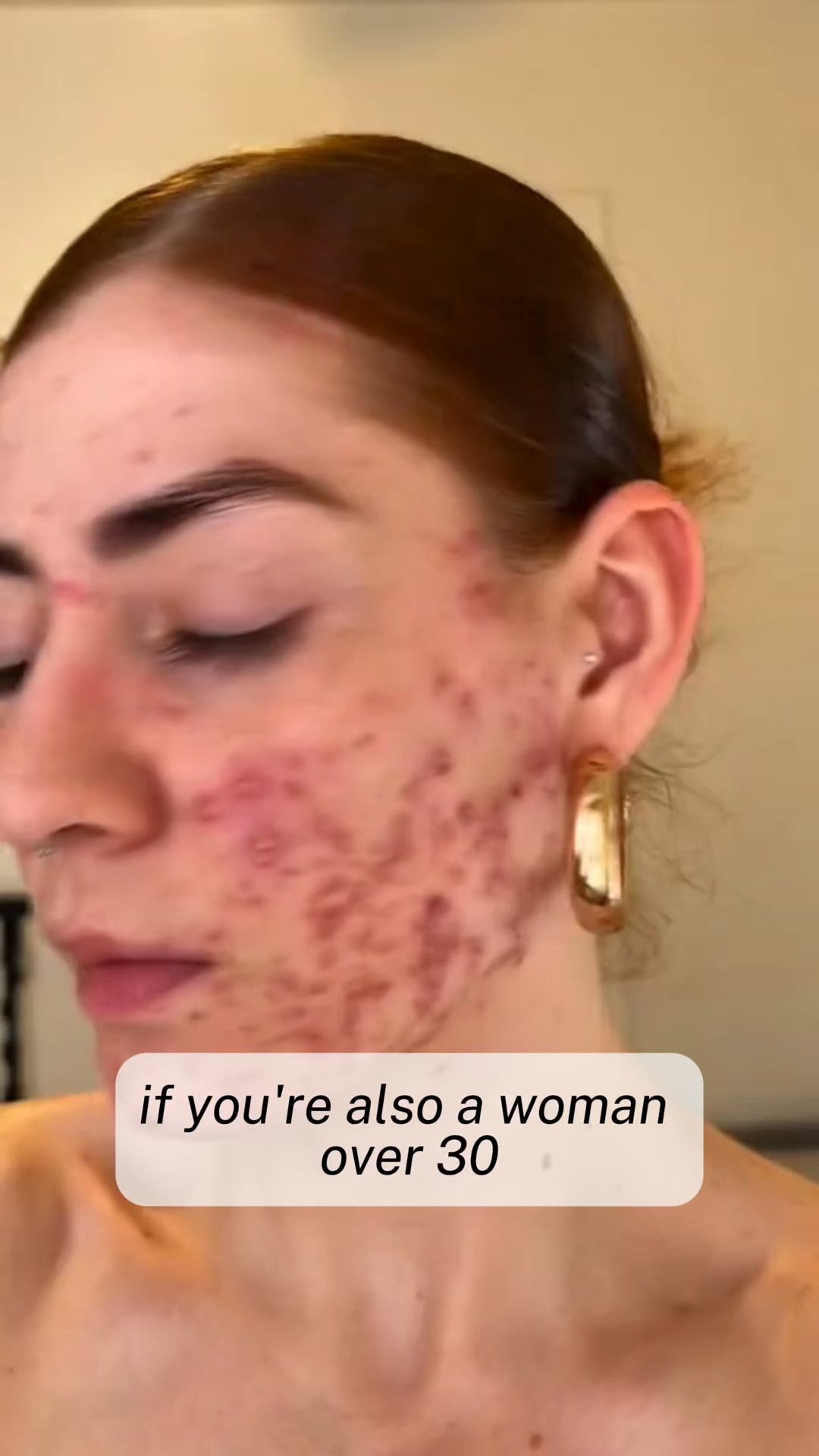 Stop acne now!