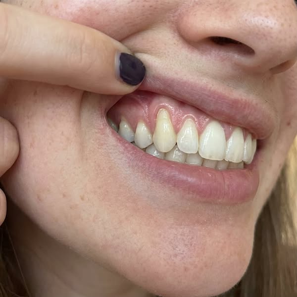 Read this if your gums are receding