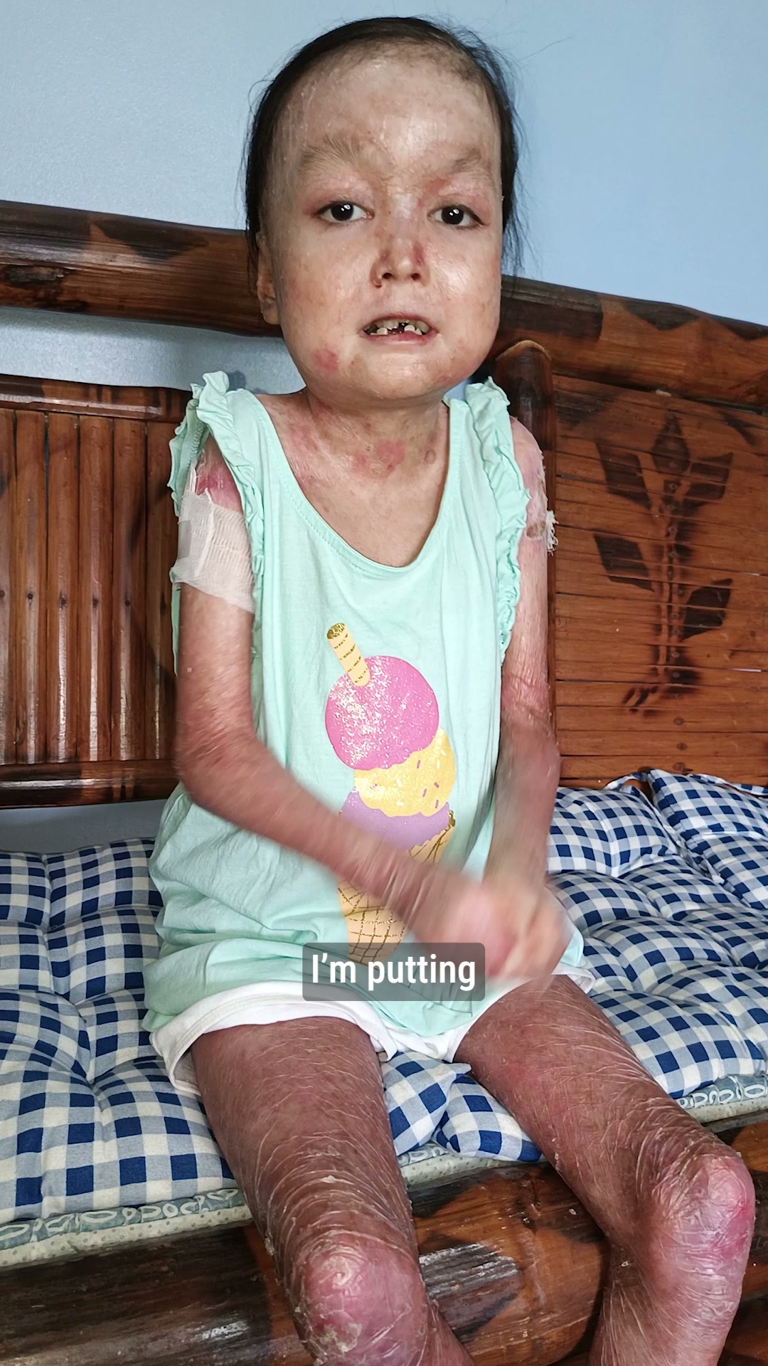 Shamila’s Skin Is Falling Off. Help Her.