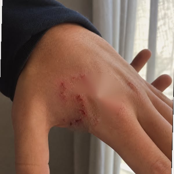 I Picked My Dog Up Wrong. He Turned And Bit Me. Hard.