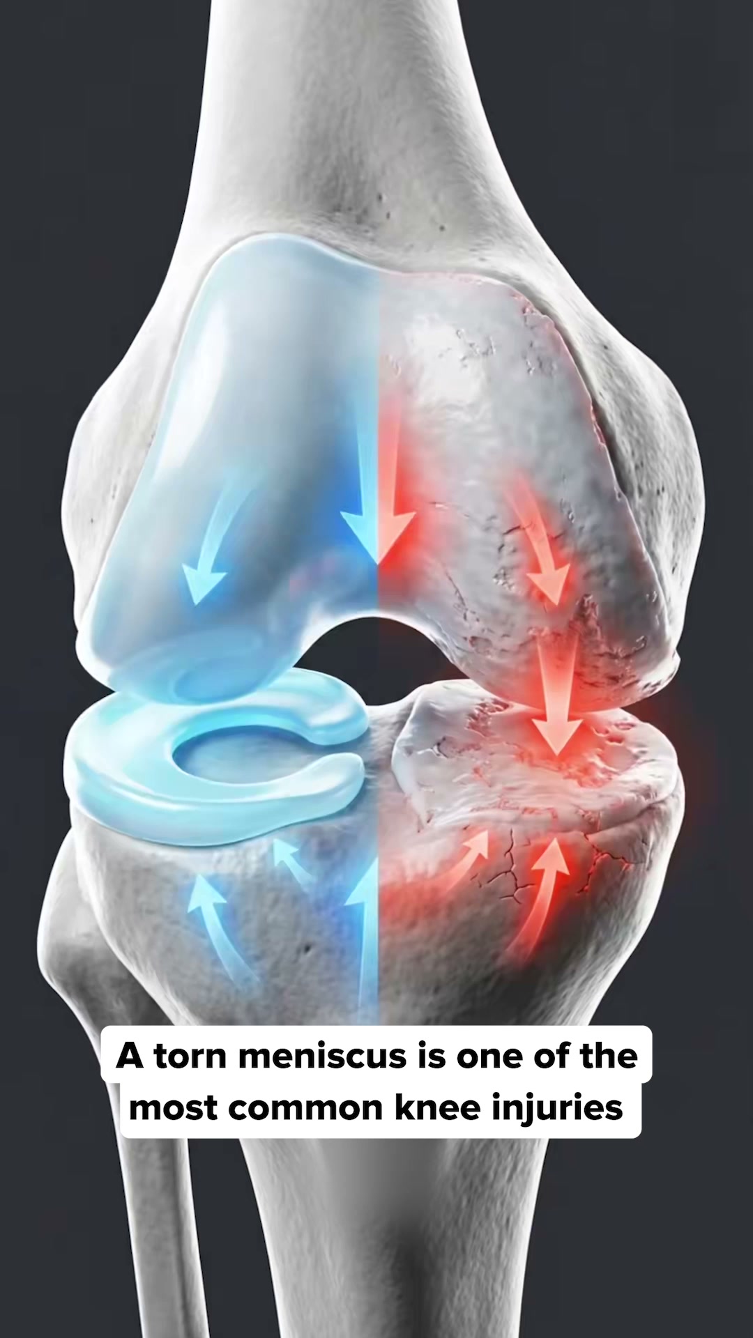 Bye Bye Knee Pain