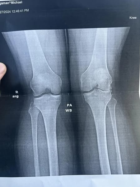 Women with arthritis: your heart is next