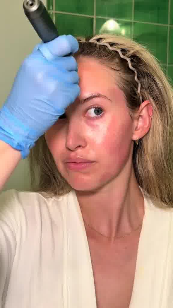 Why Women Are Microneedling At Home
