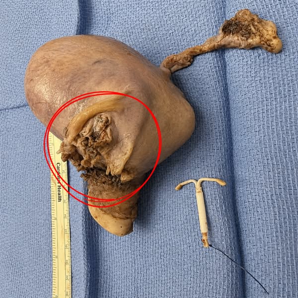 Cut bladder leaks naturally