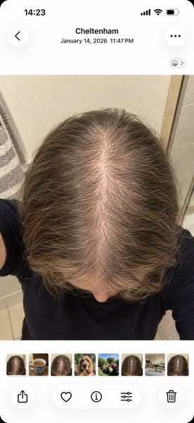 I lost 3 stone. Then I lost my hair.