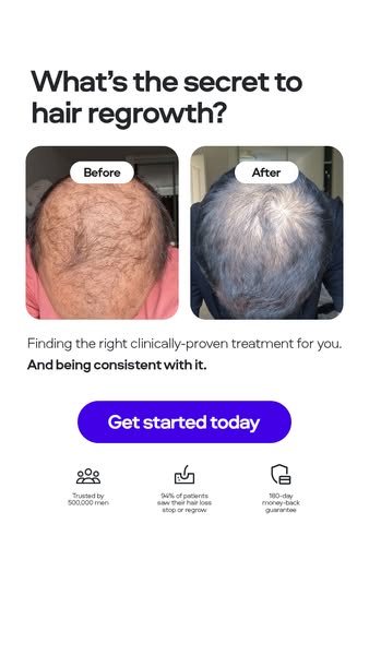 Your hairline. Your call.