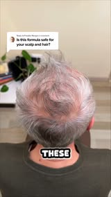 Seeing More Scalp Lately?