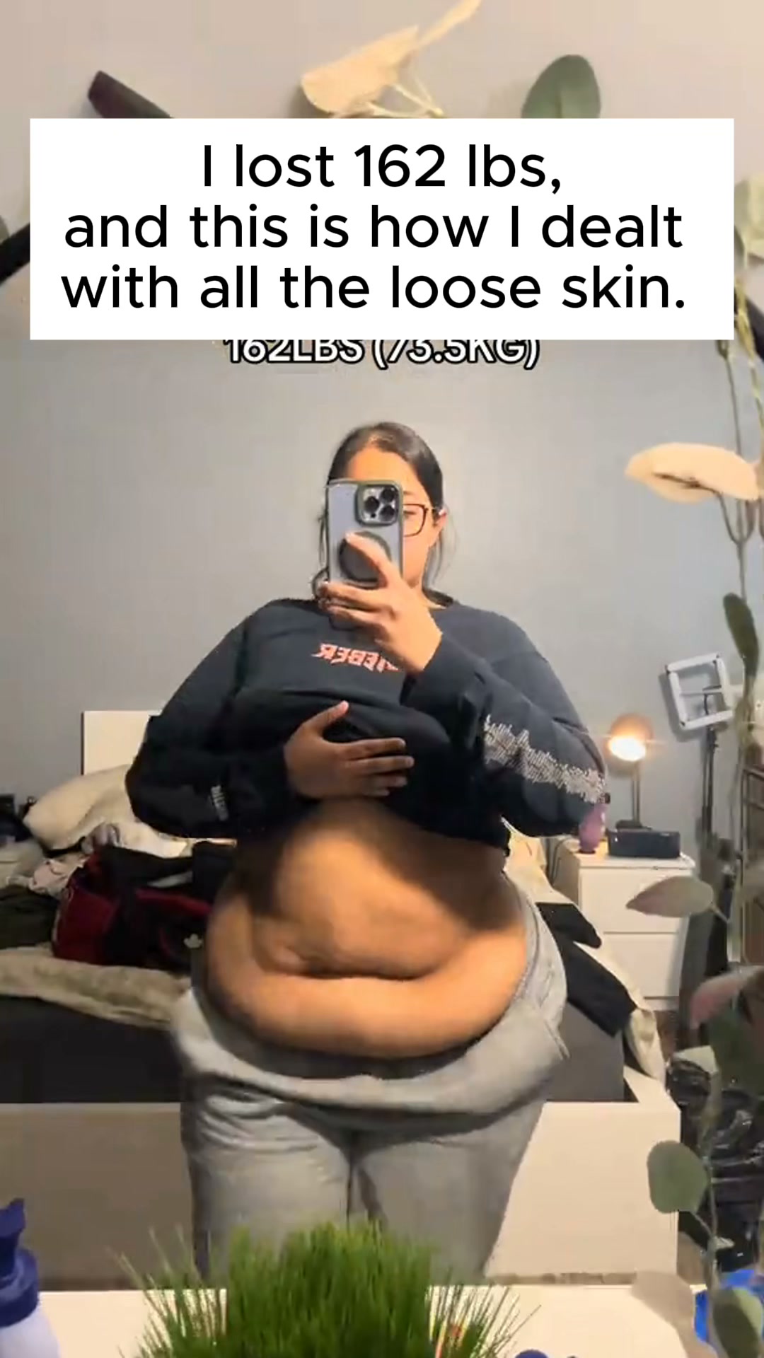 Read this before if you have stretch marks.