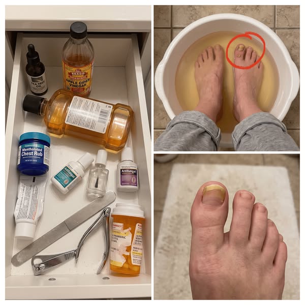 Why Nothing Works For Toenail Fungus