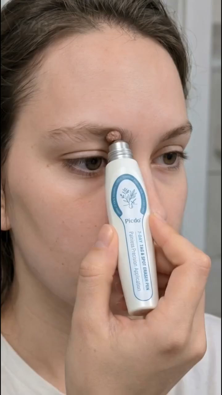 The Painless Way to Remove Skin Tags in 5 Days