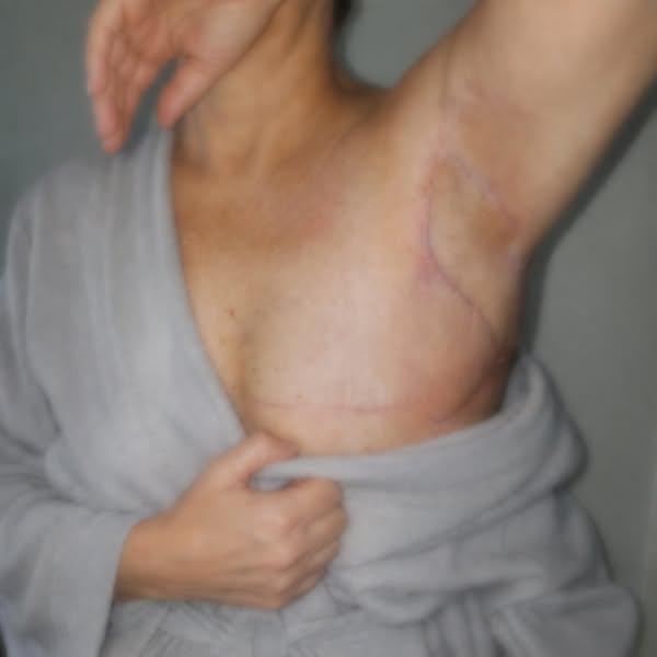 post-mastectomy? read this...