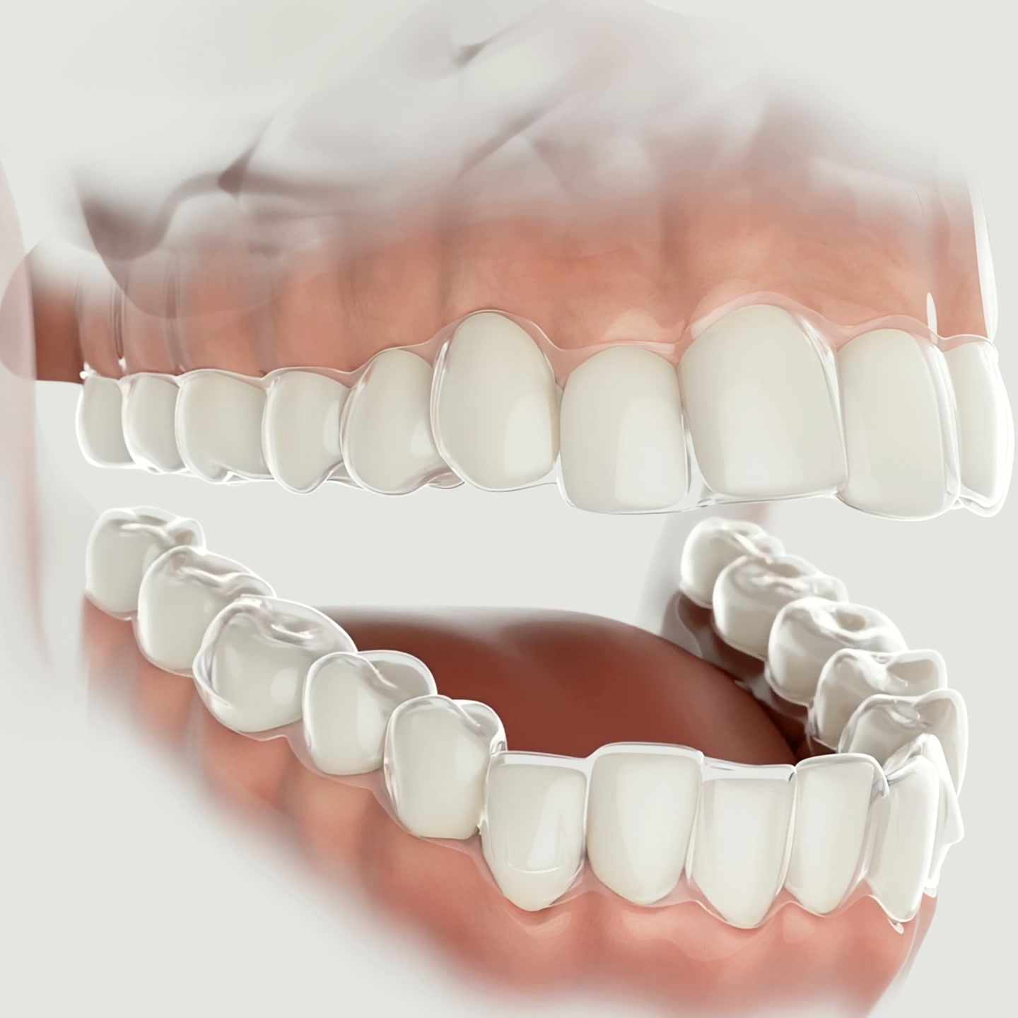 FREE Invisalign® and Smile Makeover Day Consultation