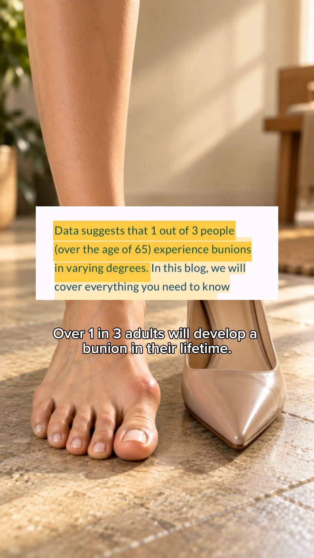 Fix Your Bunions Without Surgery