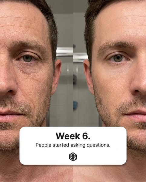 Not Botox. Just six weeks of this.