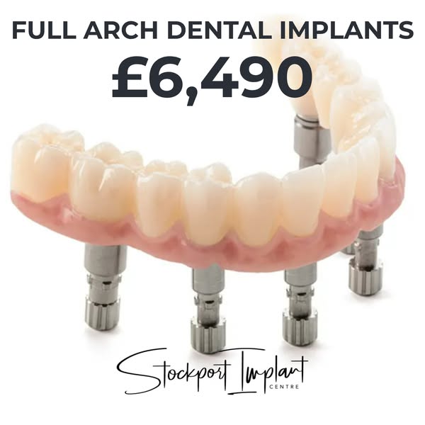 Full Arch Dental Implants From £6,490
