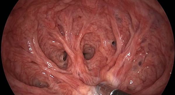 Flomax effects taking a toll on you?