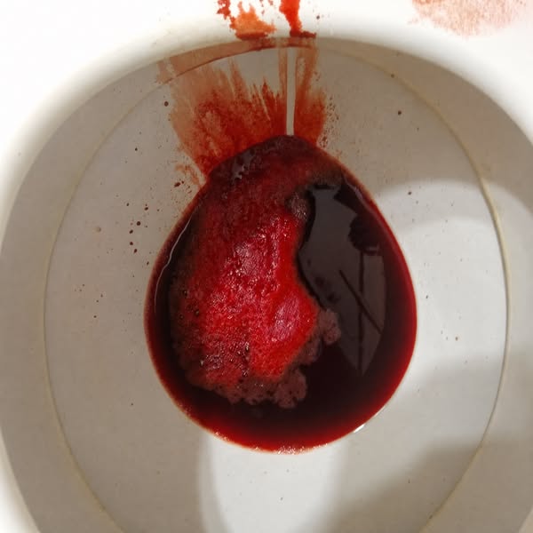 This Finally Fixed My Hemorrhoids