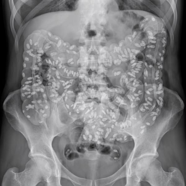 La Única Forma de Limpiar los Parásitos del Cuerpo