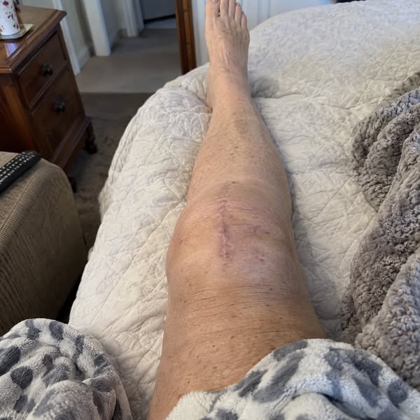 Read If Knee Pain After Replacement