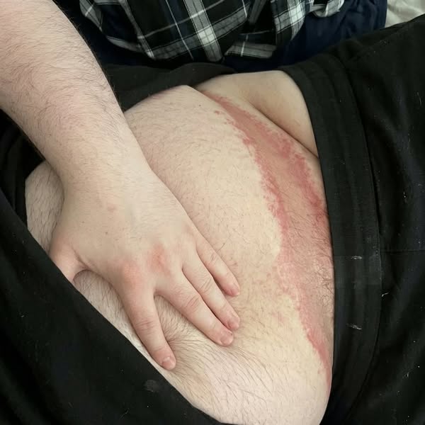 Skin Fold Rash? Red This Before It gets Worse!