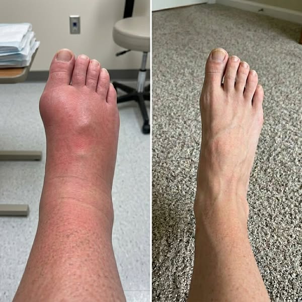 "4 years of my oedema swelling gone in 1 month?"